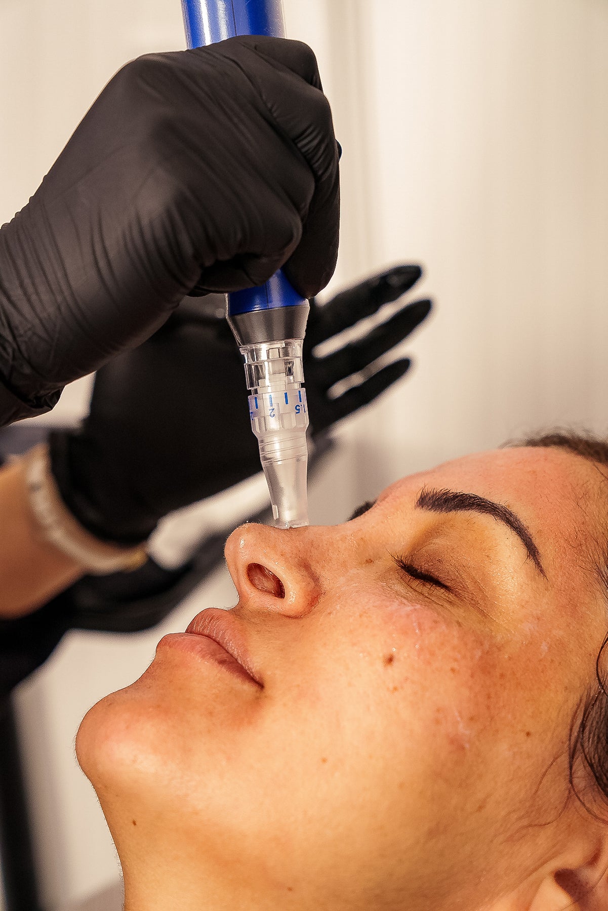 SkinPen Microneedling