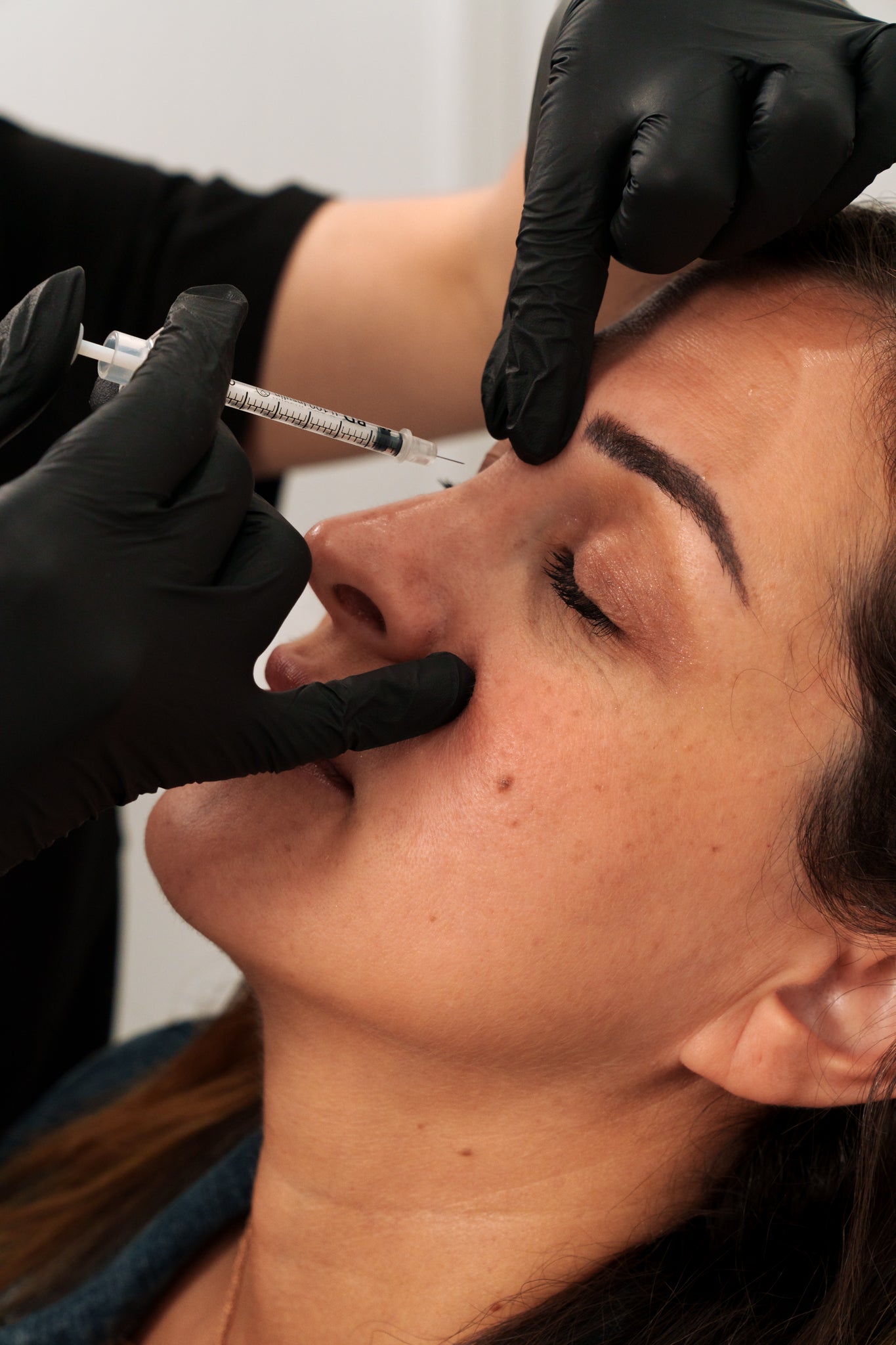 Nose Filler (non-surgical nose job)