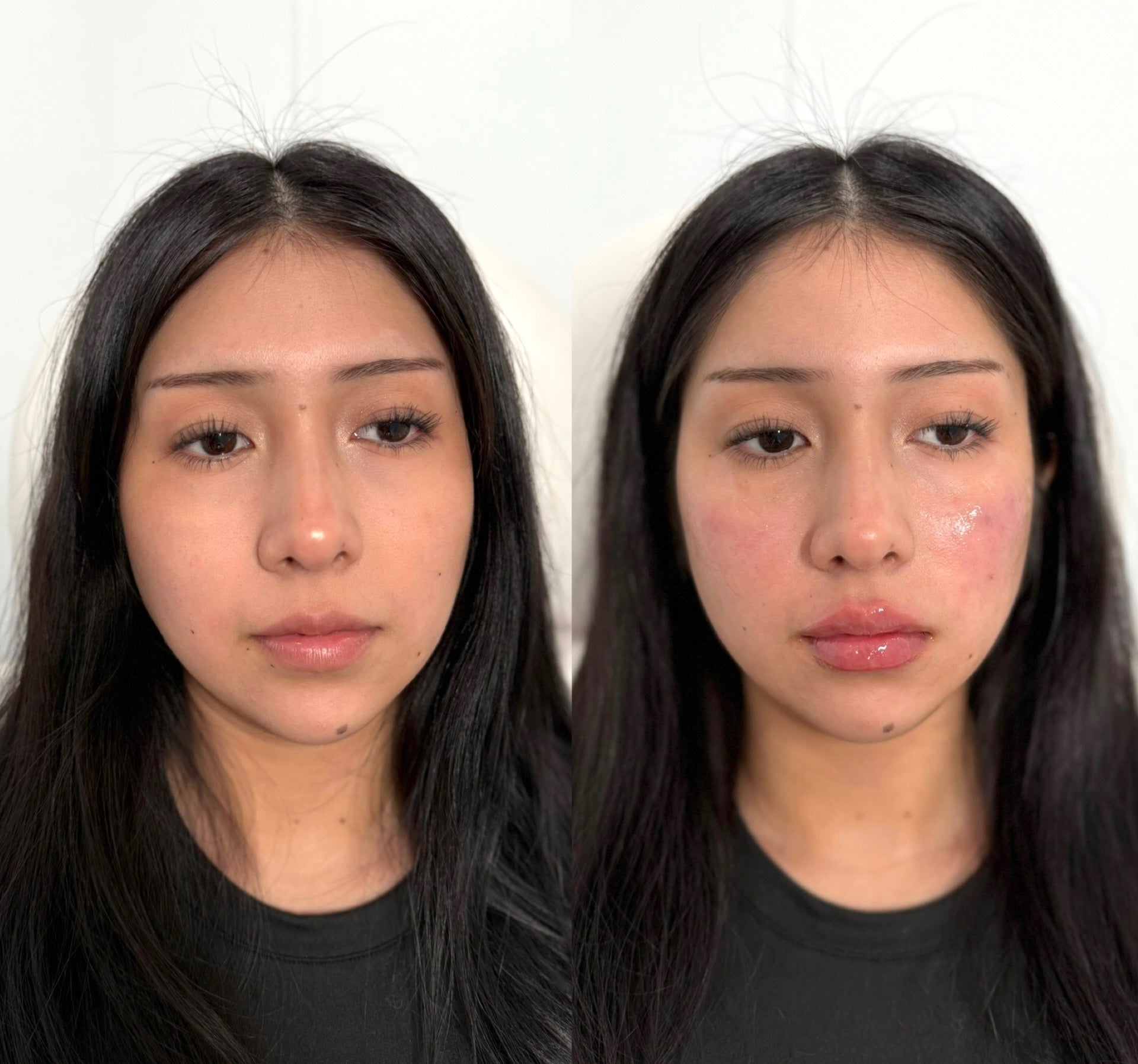 How Long Do Dermal Fillers Last? Longevity by Type and Area