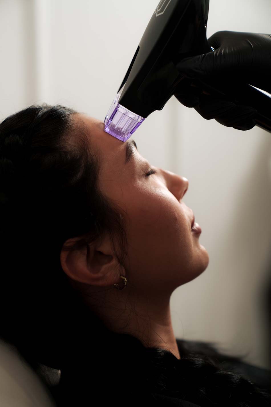 Microneedling for Acne Scars in Orange County