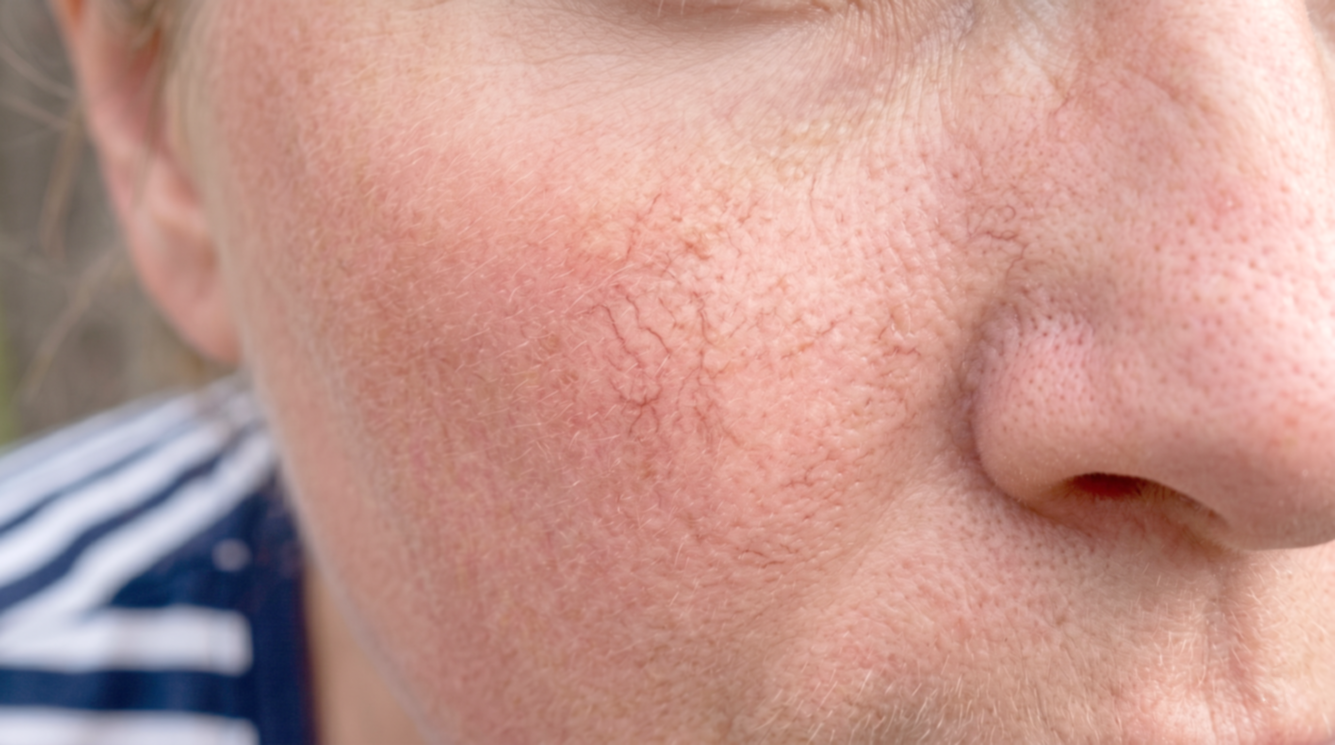 Laser Treatment for Spider Veins on the Face | Motus AZ+ at Glow Up Med Spa