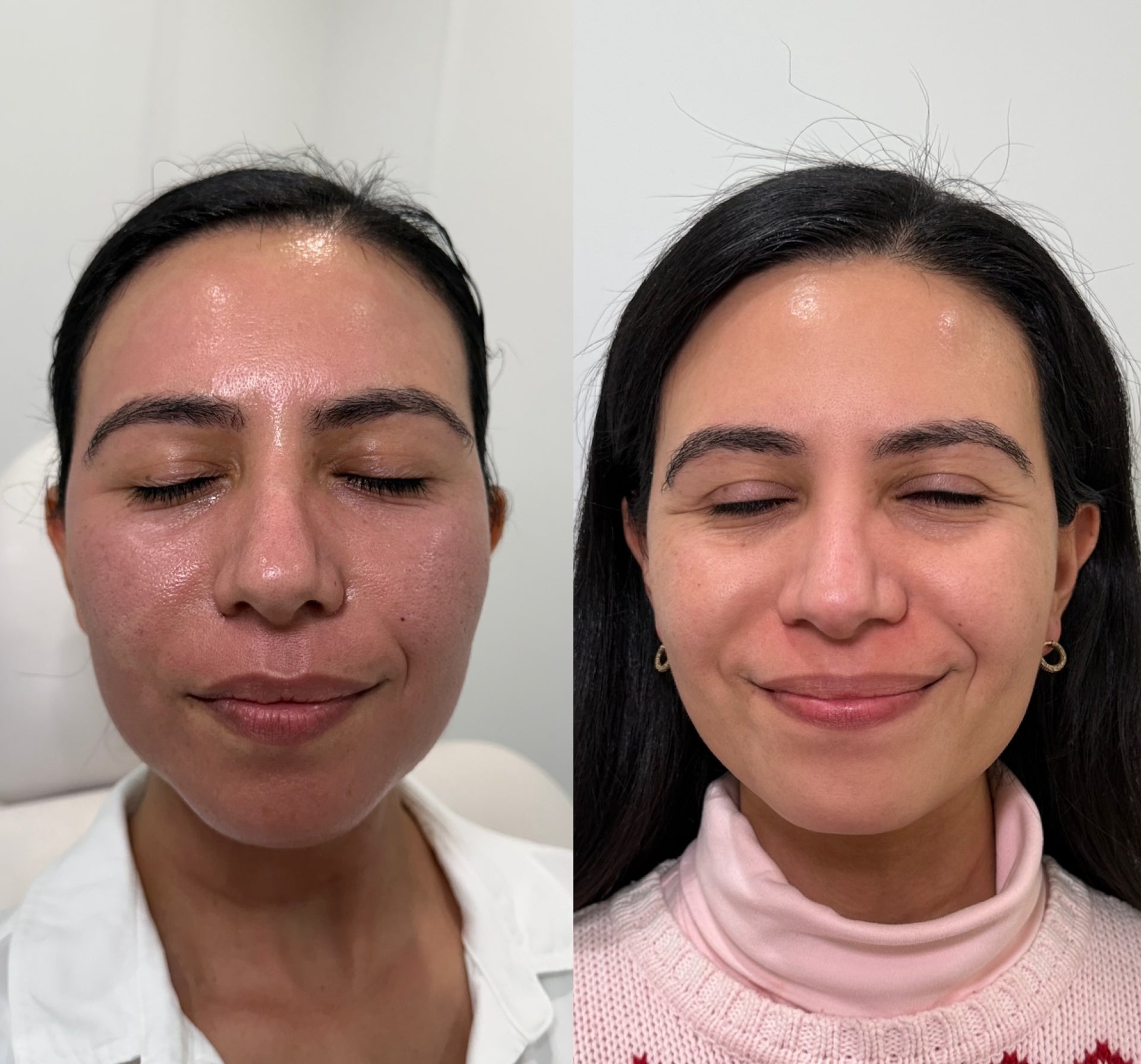 SkinPen Microneedling