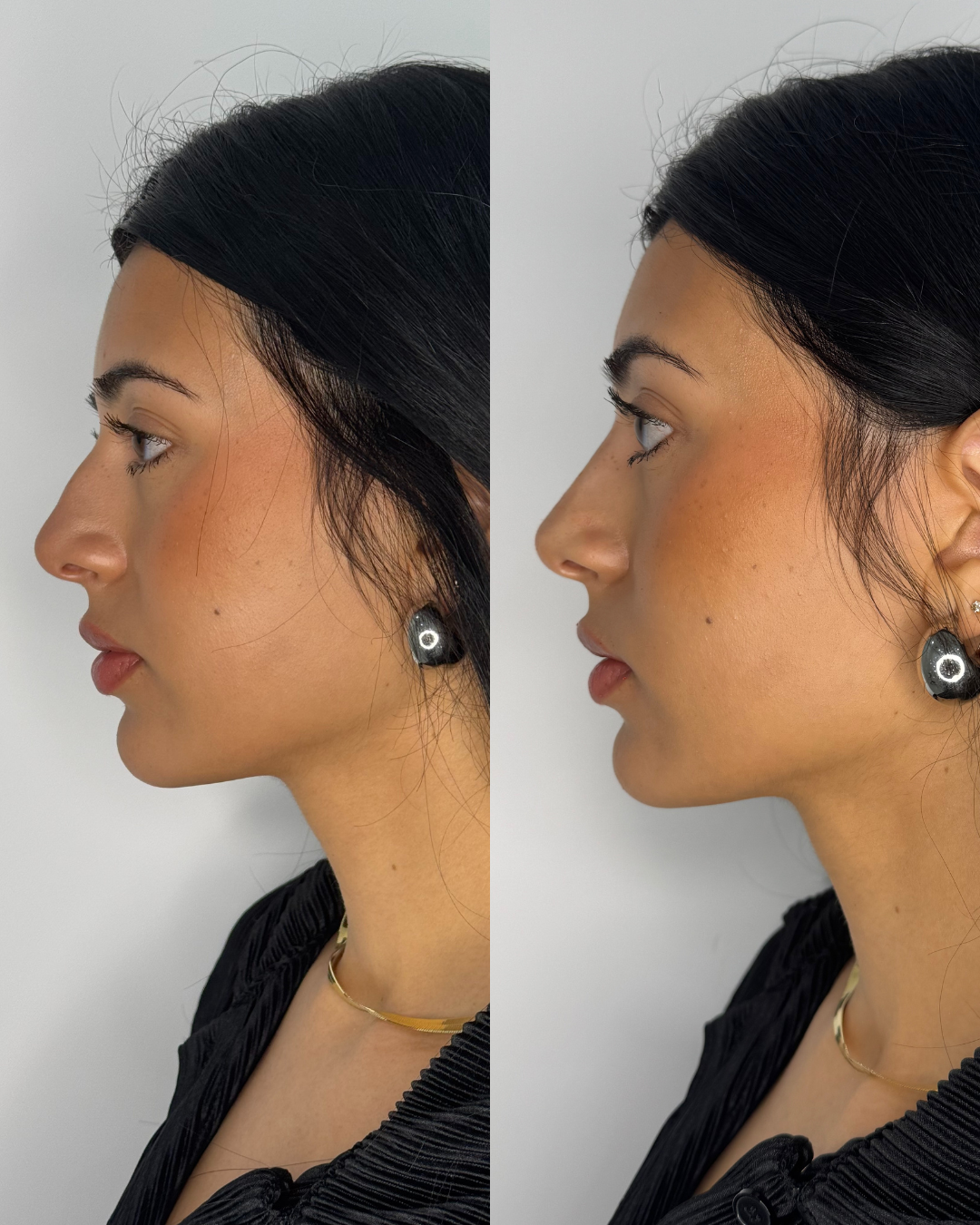 Nose Filler