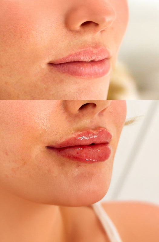 Lip Filler