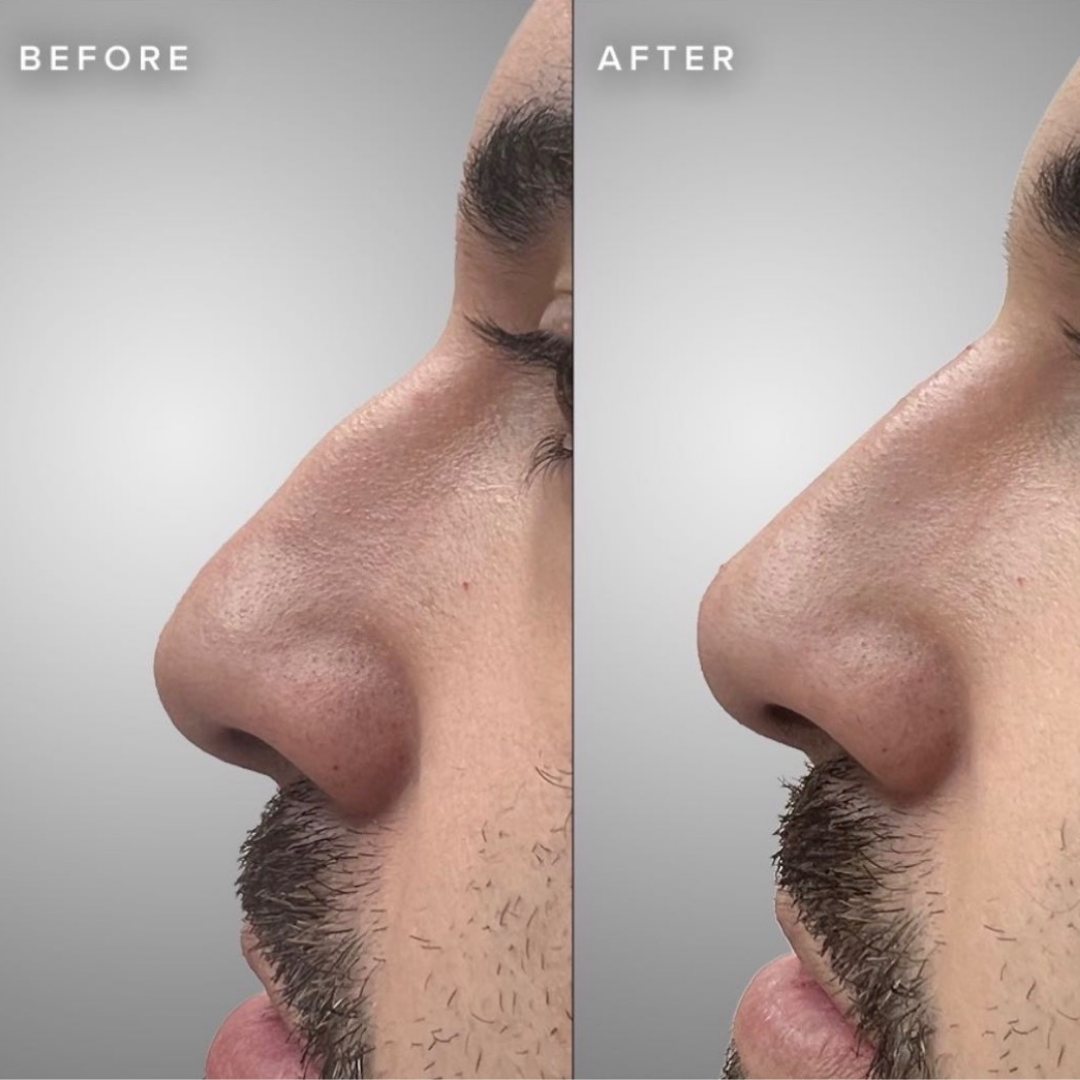 Nose Filler (non-surgical nose job)