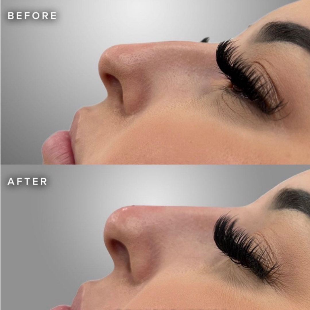 Nose Filler (non-surgical nose job)