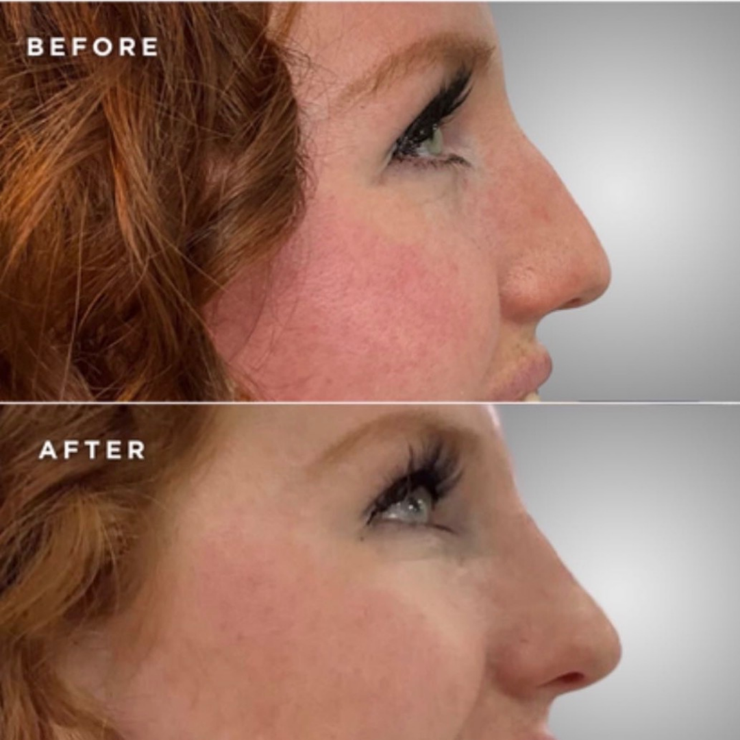 Nose Filler (non-surgical nose job)