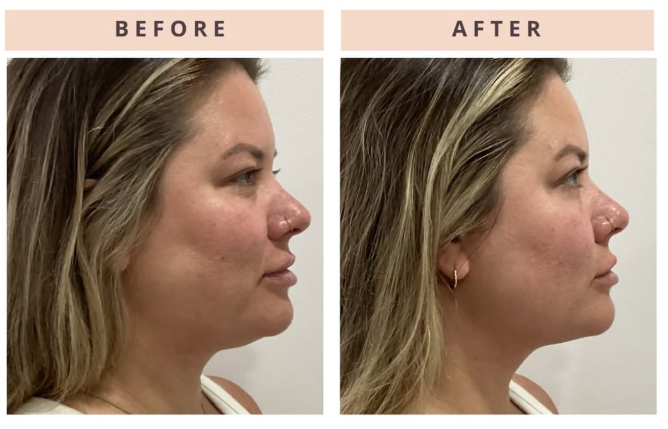 ONDA Pro Cellulite & Contouring