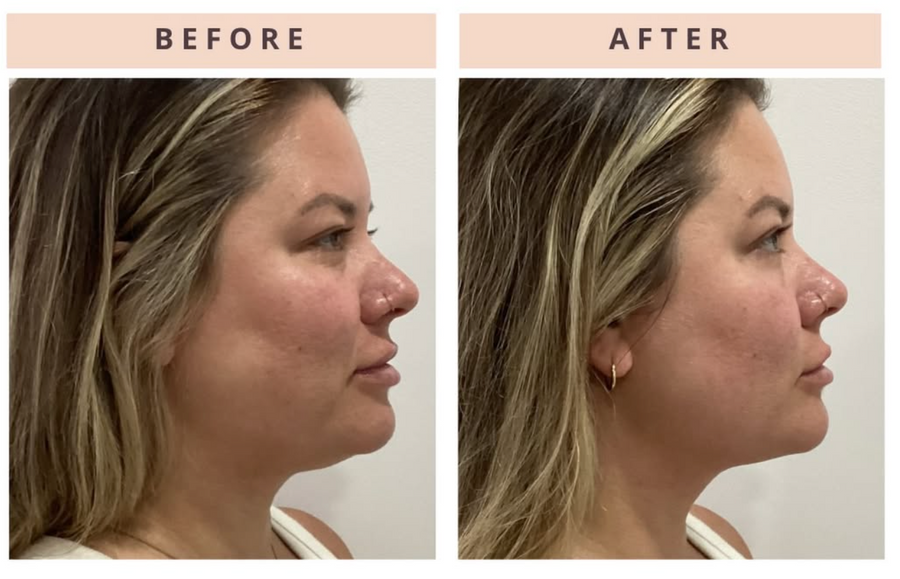 ONDA Pro Cellulite & Contouring
