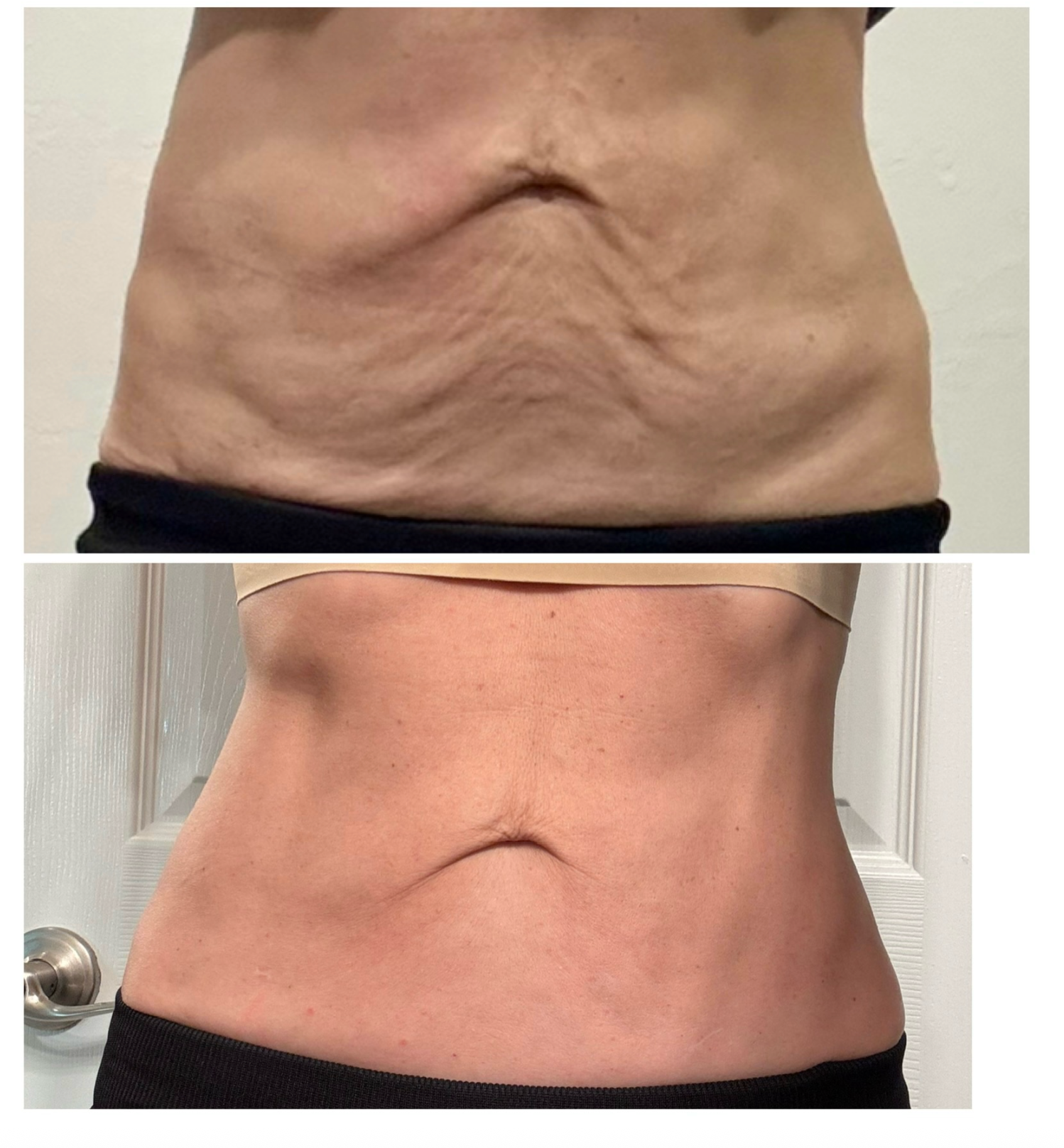 ONDA Pro Cellulite & Contouring