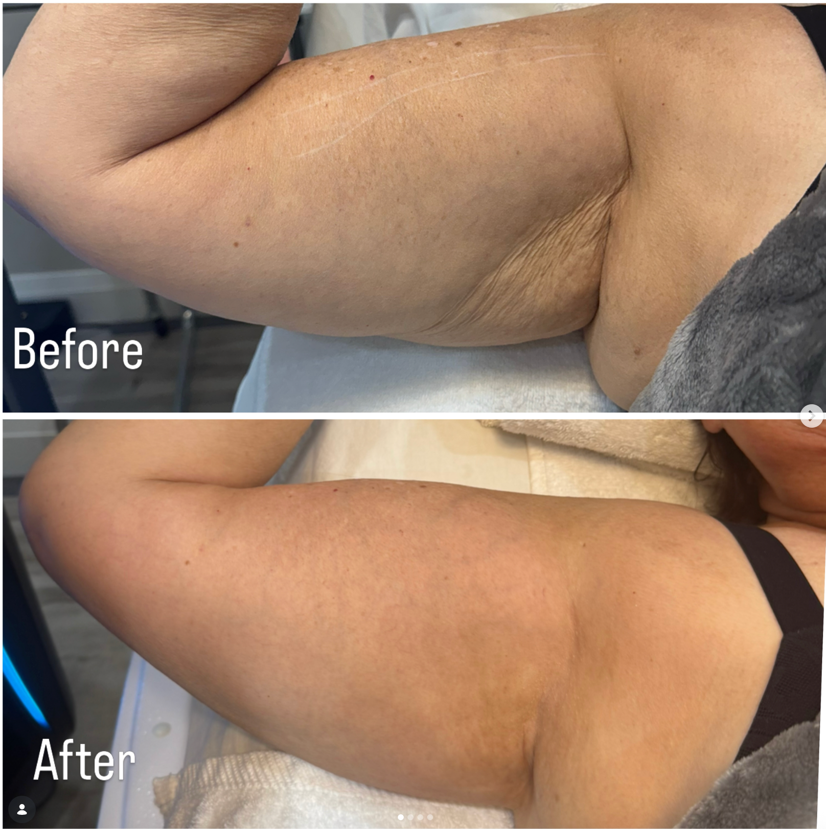 ONDA Pro Cellulite & Contouring