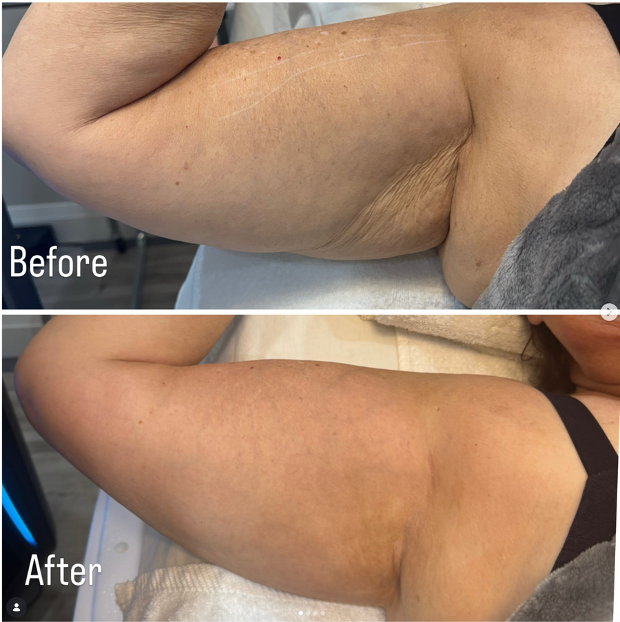 ONDA Pro Cellulite & Contouring
