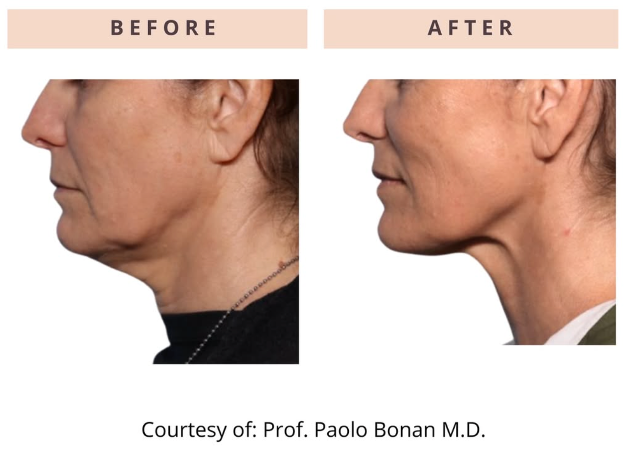 ONDA Pro Cellulite & Contouring