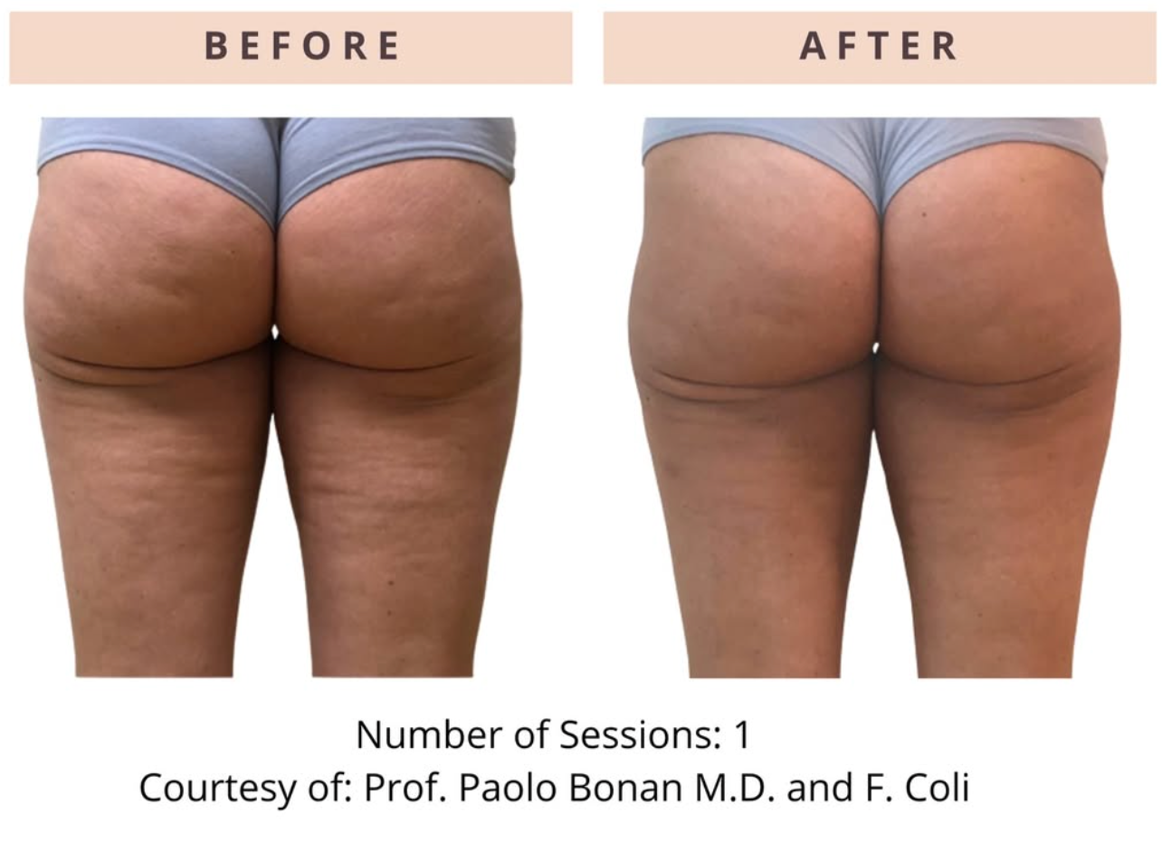ONDA Pro Cellulite & Contouring