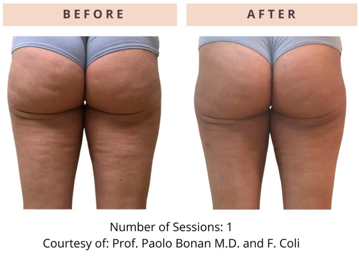 ONDA Pro Cellulite & Contouring