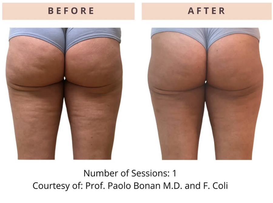 ONDA Pro Cellulite & Contouring