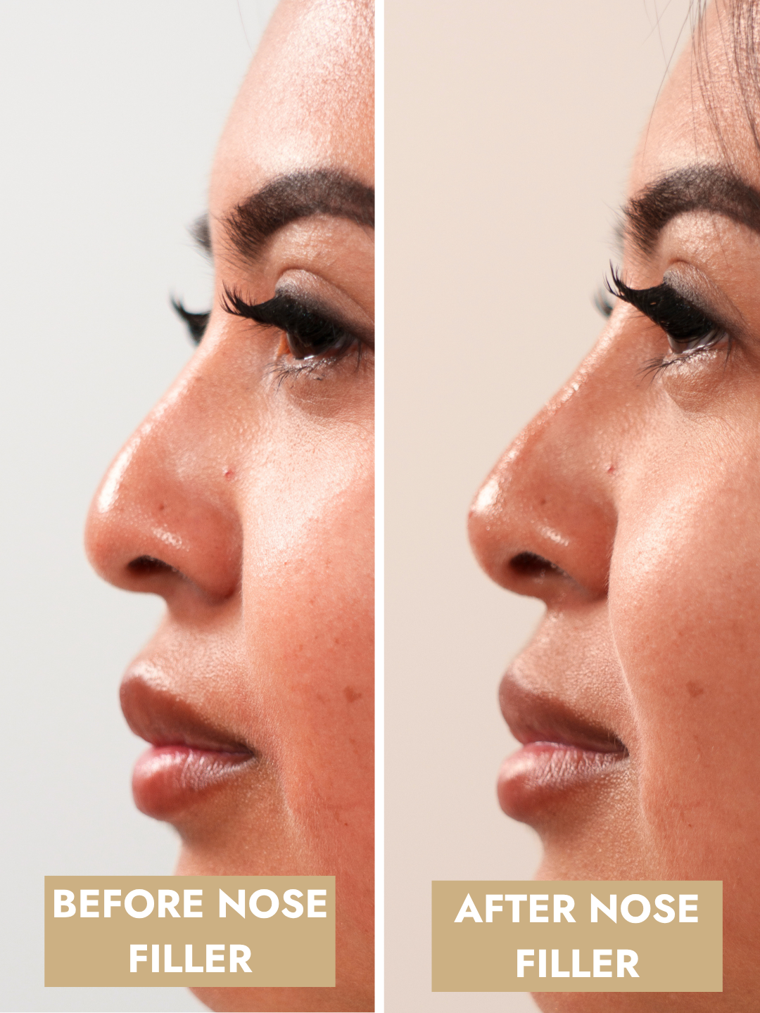 Nose Filler (non-surgical nose job)