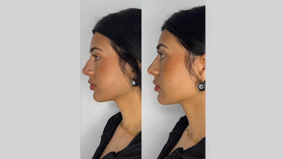 Nose Filler (non-surgical nose job)