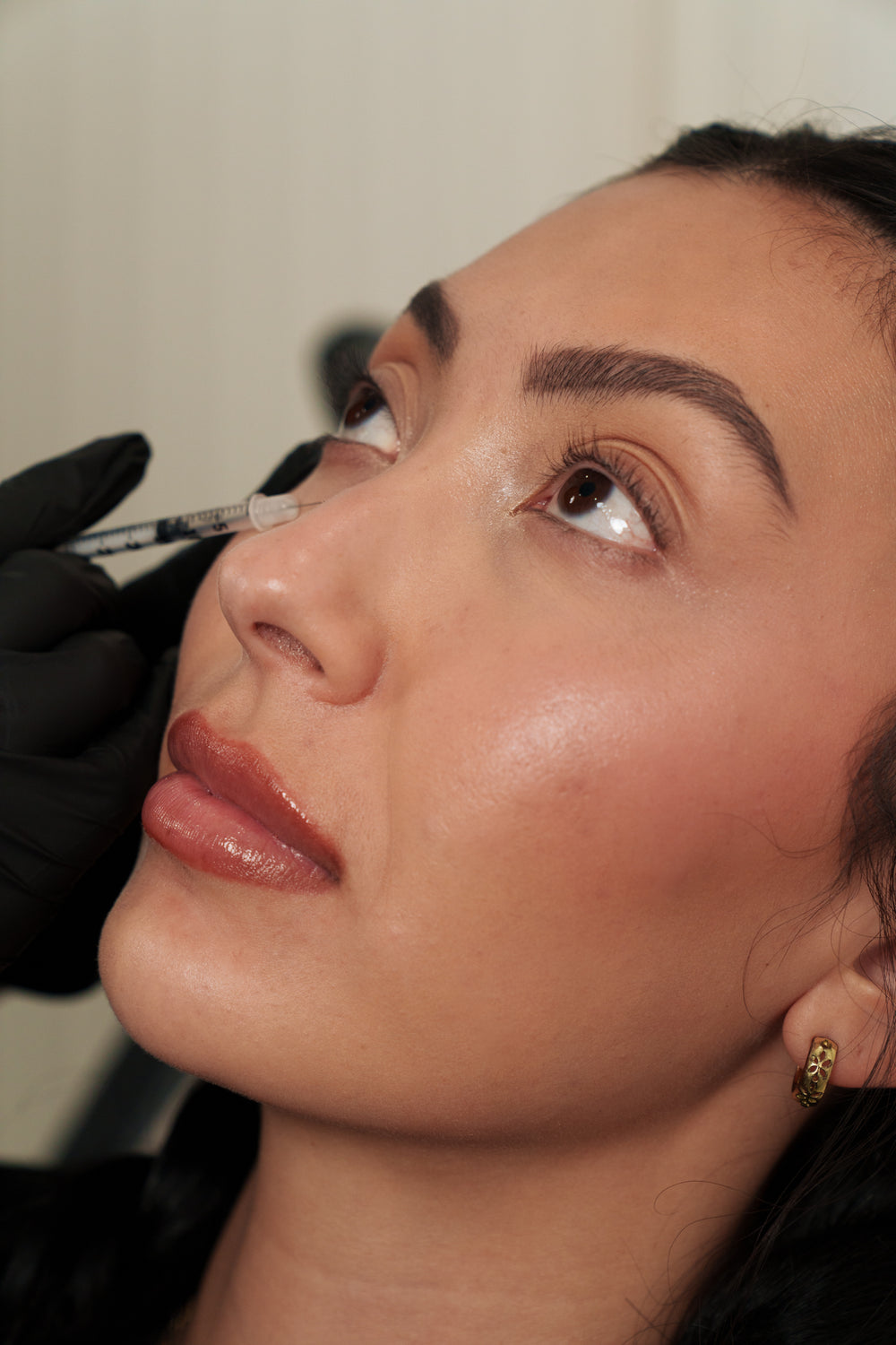 Dermal Fillers