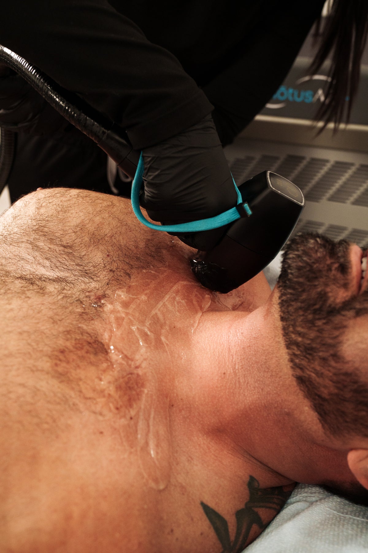 Laser Hair Removal
