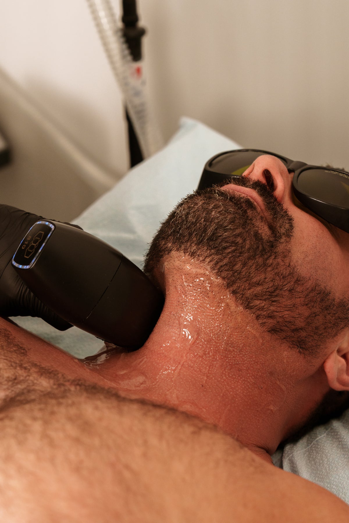 Laser Hair Removal