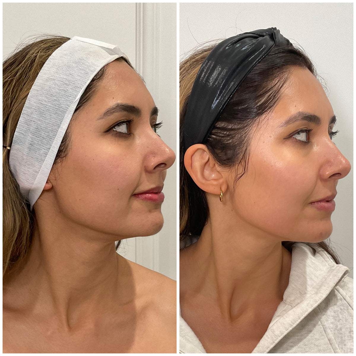 before and after comparison of a woman after morpheus8 treatment