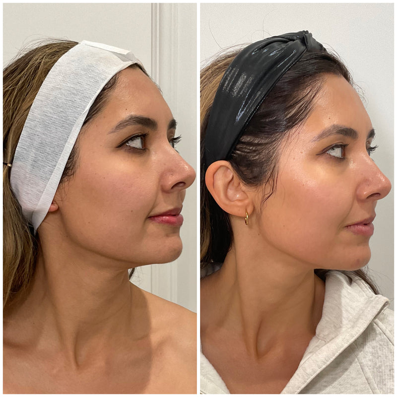 before and after comparison of a woman after morpheus8 treatment