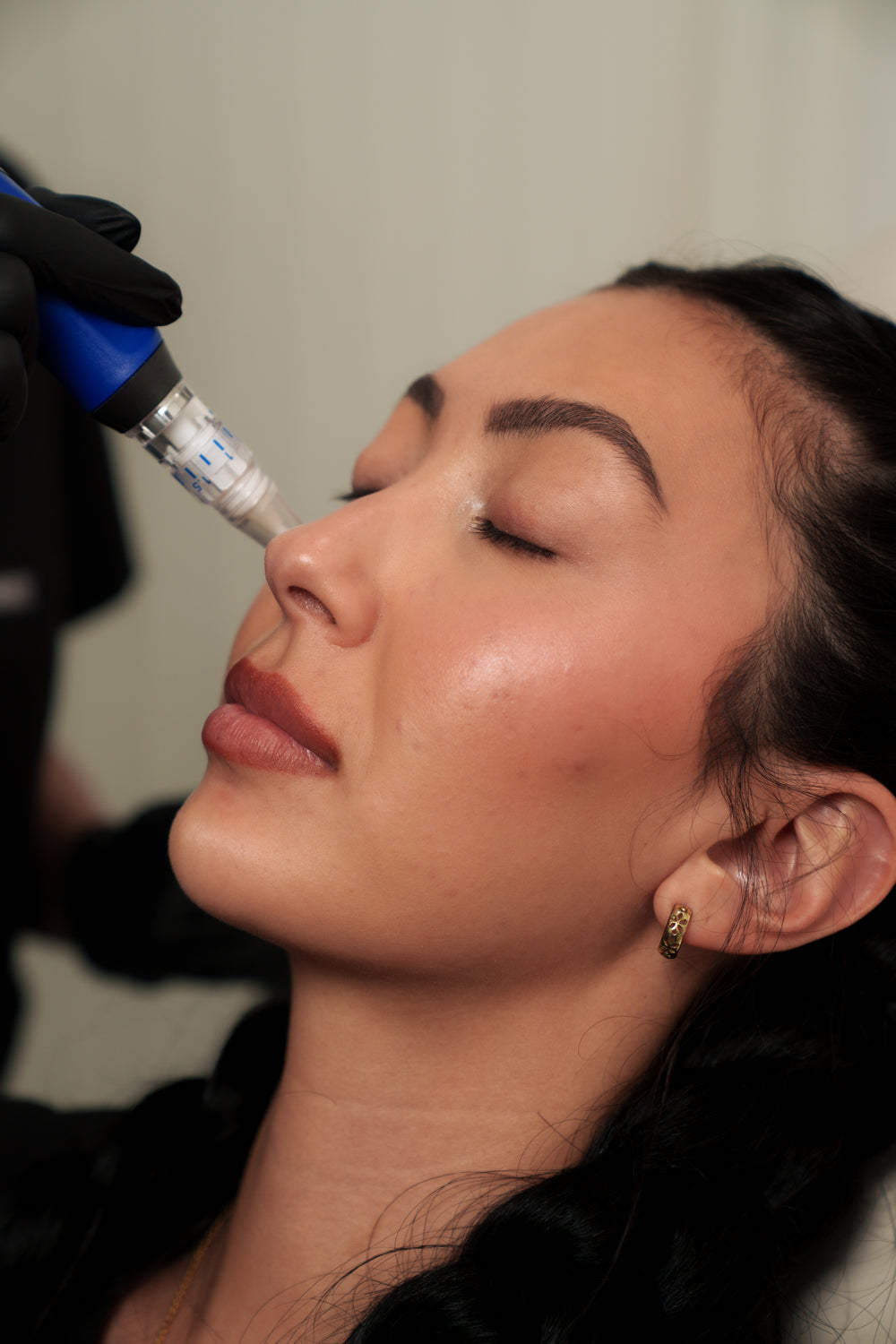 SkinPen Microneedling