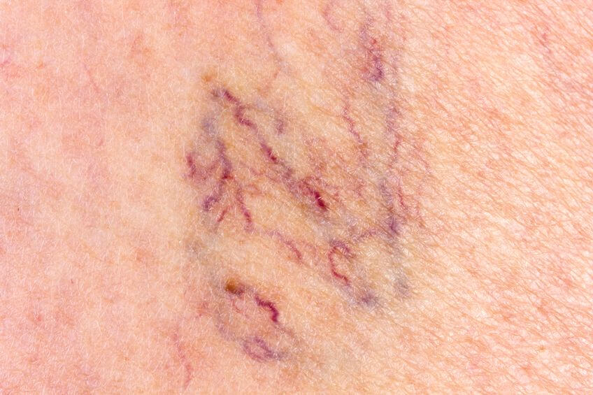 Spider Vein Treatment