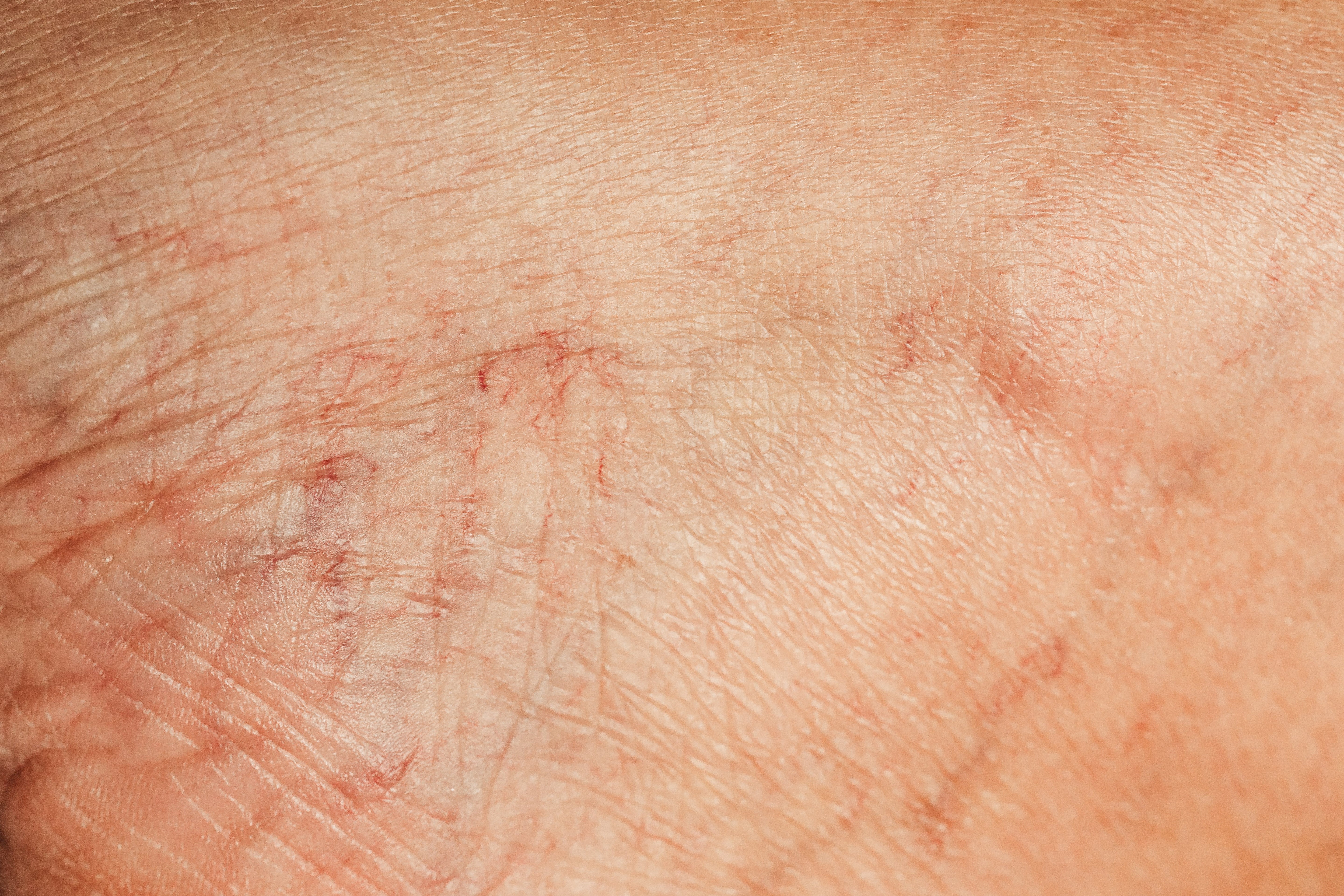 Spider Vein Treatment