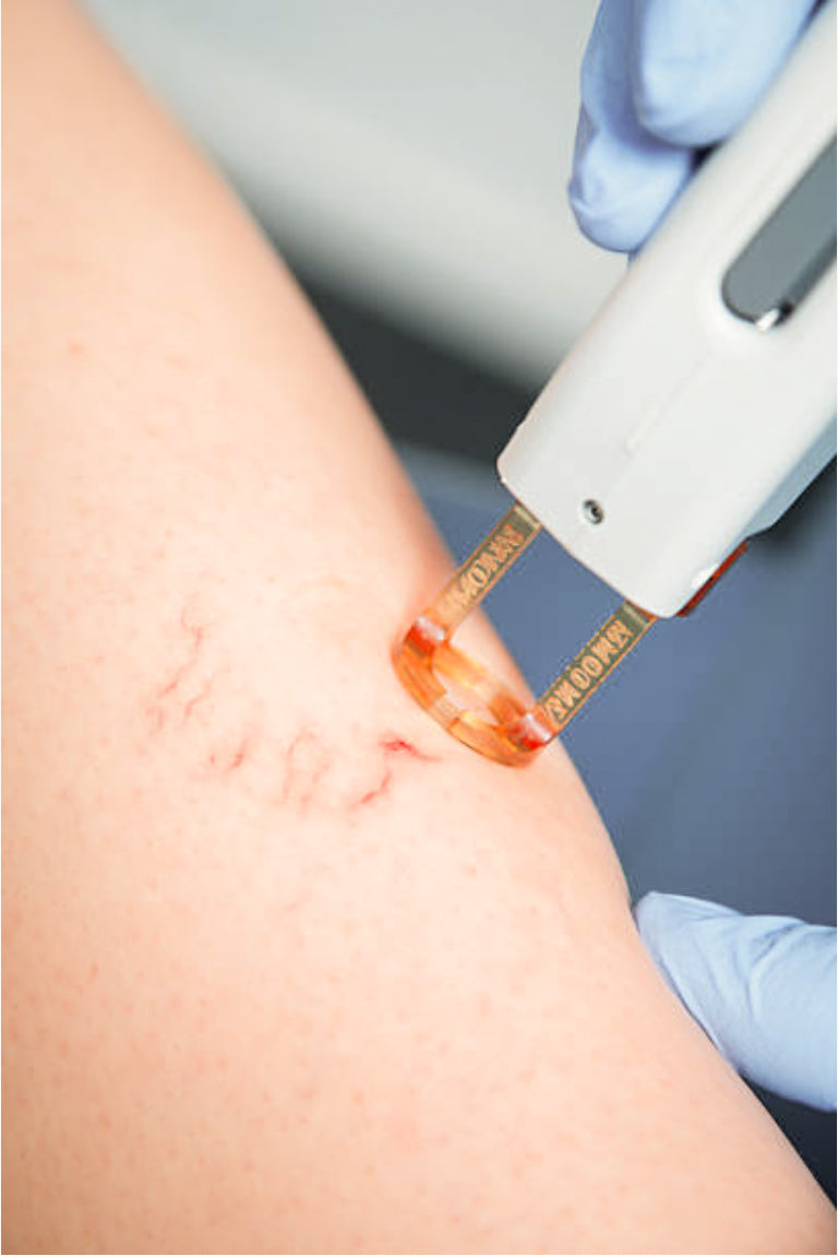 Spider Vein Treatment