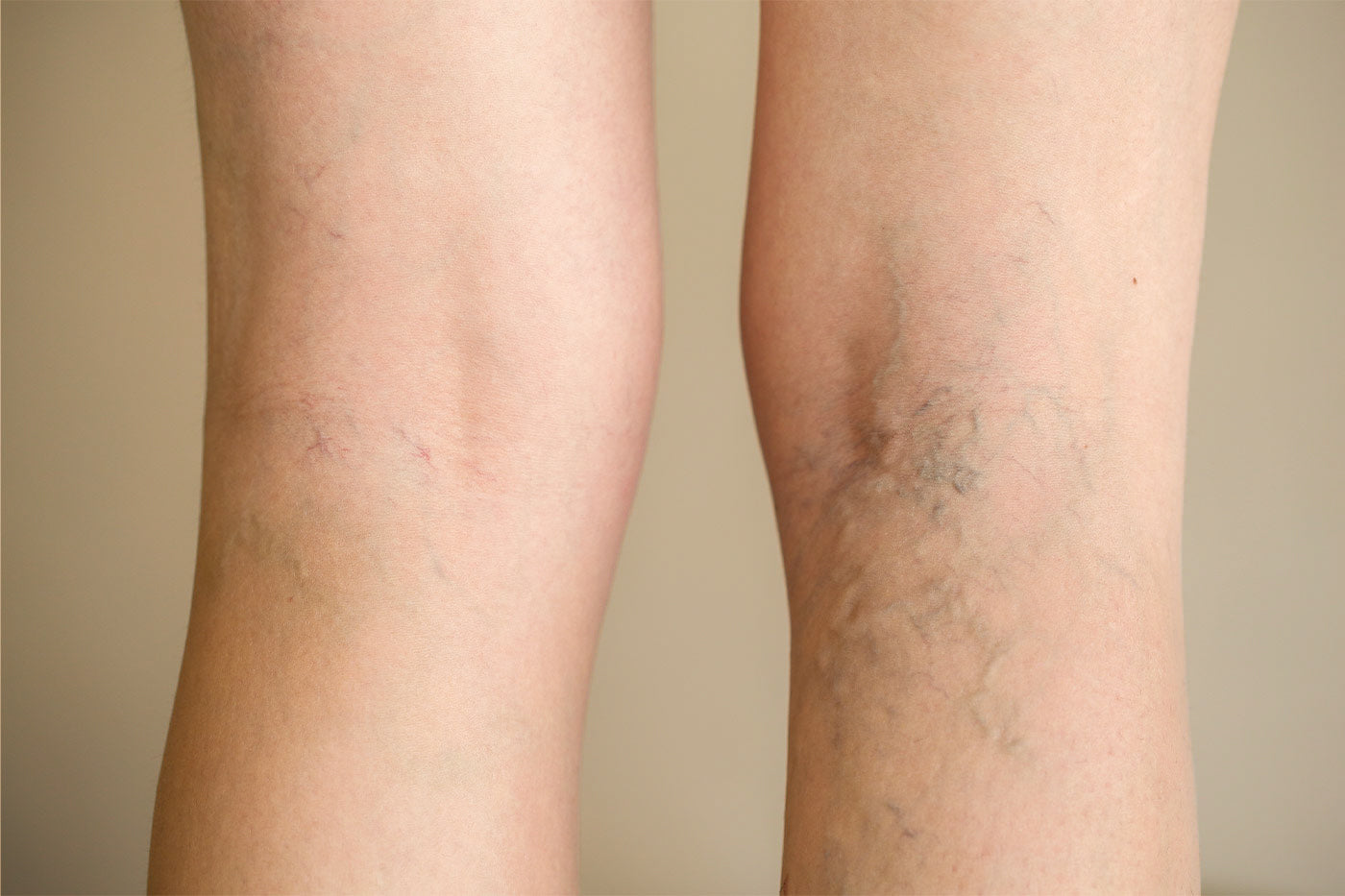 Spider Vein Treatment