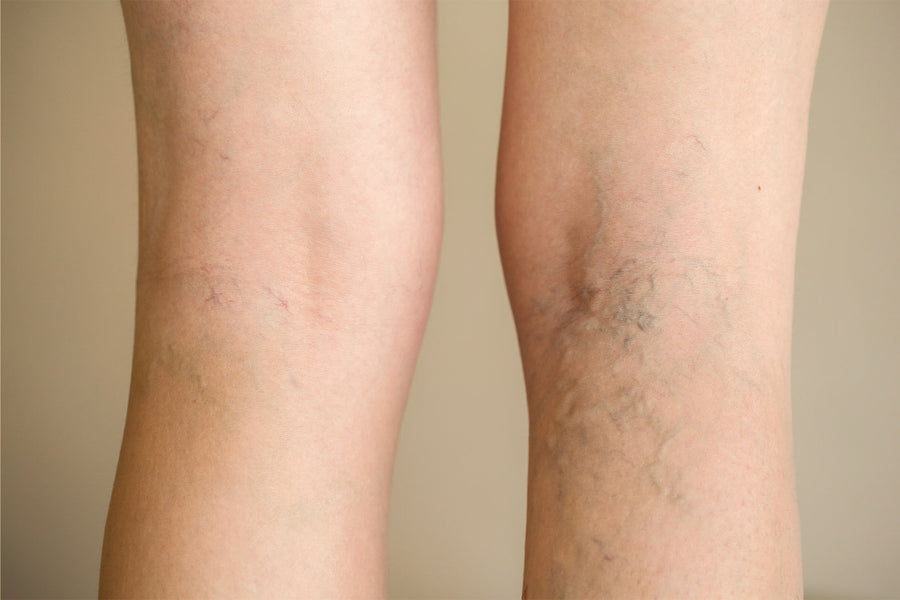 Spider Vein Reduction