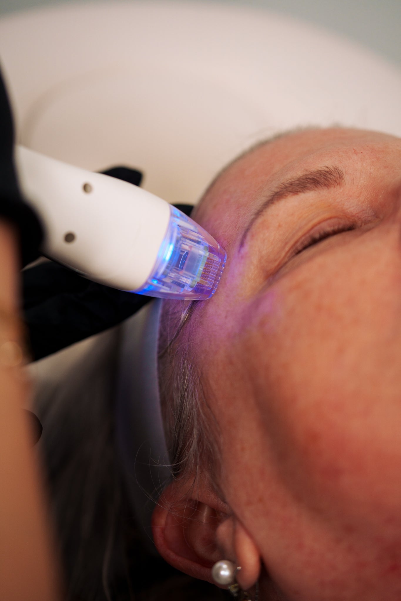 VirtueRF Microneedling