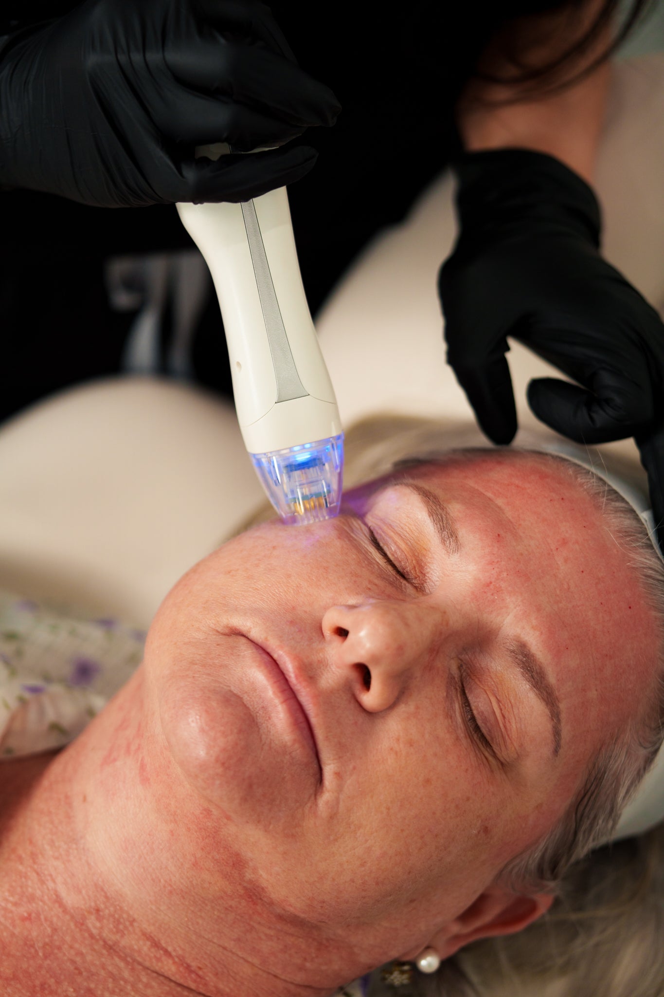 VirtueRF Microneedling